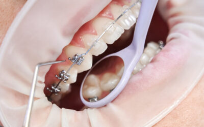 5 sfaturi pentru a supravietui primei saptamani cu aparatul dentar