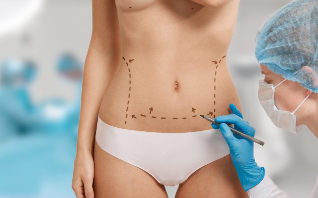 Corpul tău, regulile tale: Ghidul tău despre liposucție și abdominoplastie